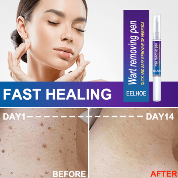 Wart Remover Skin Pen Gel
